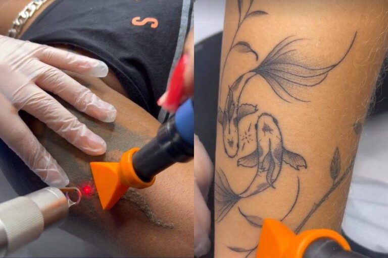 Remoção De Tatuagens Cresce Com Medo Da Associação De Símbolos Ao Crime