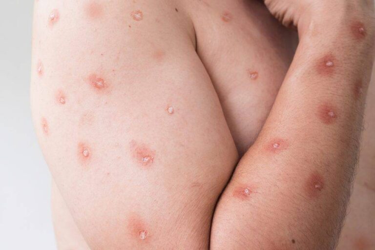 Oito Estados Entram Em Alerta Máximo Para Mpox No Brasil