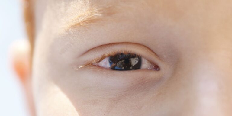 Fotoceratite exige cuidados redobrados no verão