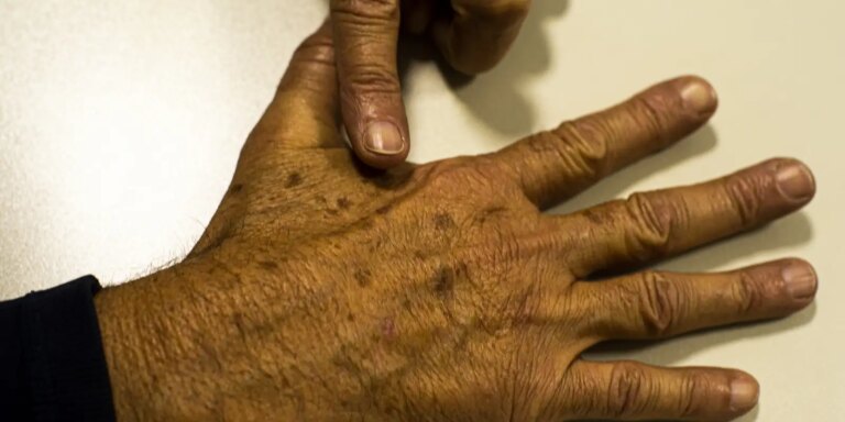 Câncer de pele: falta de dados sobre pacientes dificulta prevenção