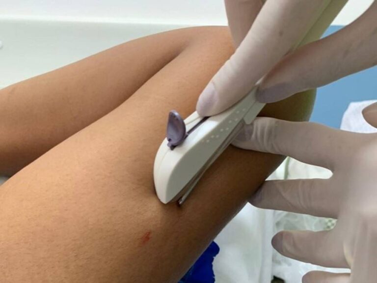 Saúde Amplia Capacitação Para Implante Contraceptivo No SUS